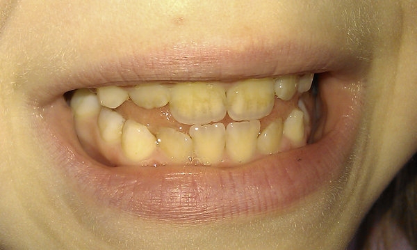 Налет на зубах у ребенка 7 лет