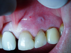 Что такое киста зуба?