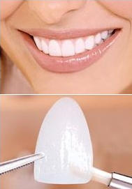 Плюсы и минусы реставрации зубов люминирами