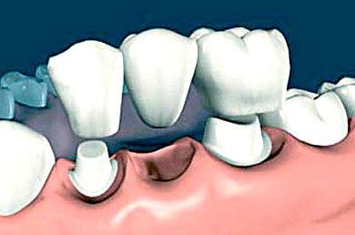 Несъемный мостовидный зубной протез