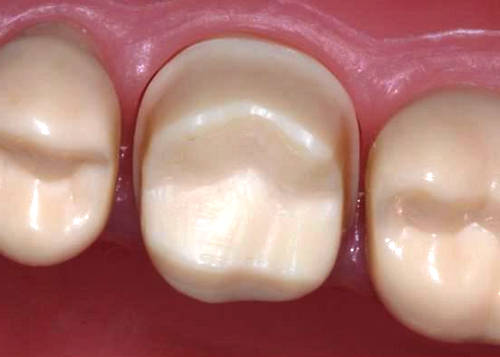 Обточка зубов под металлокерамику