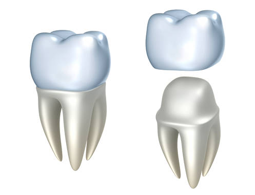 Зубы из металлокерамики