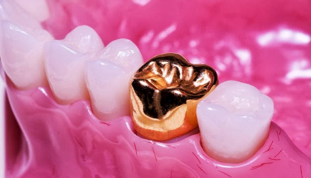 Преимущества продажи зубного золота в Moggem