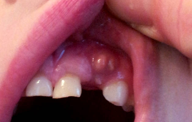 Почему появляются черные точки на зубах у ребенка?