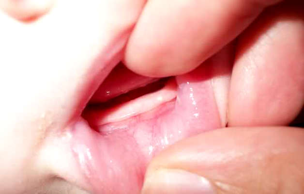 Нарост на десне при прорезывании зубов