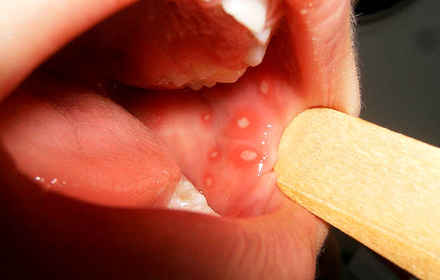 Стоматит у детей симптомы и лечение профилактика фото покраснение на губах thumbnail