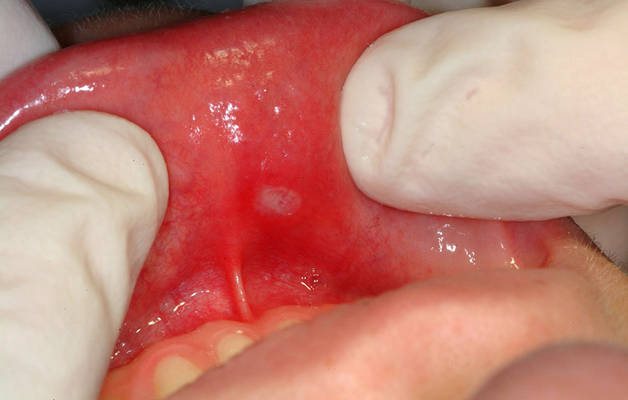 Стоматит у ребенка на губе