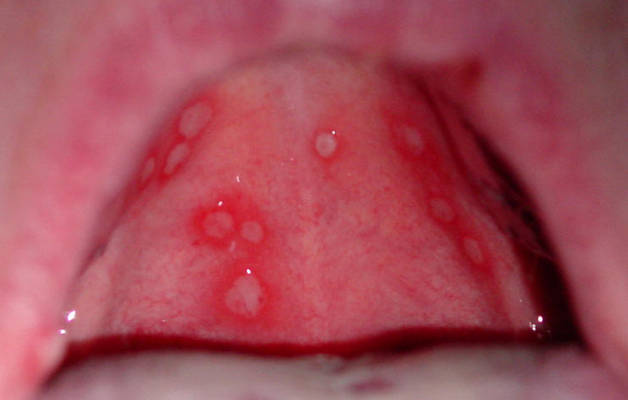 Стоматит у детей во рту и на губах thumbnail