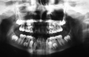 Лечение некроза челюсти народными средствами thumbnail