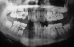 Лечение остеомиелита челюсти народными средствами отзывы thumbnail