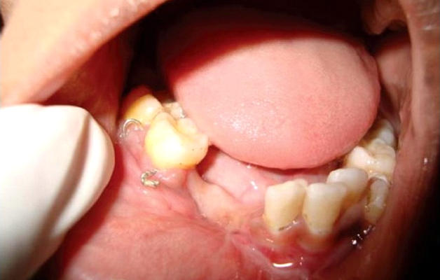 Остеомиелит зуба лечение народными средствами thumbnail
