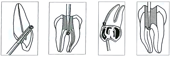 Восстановление перфорации корня зуба