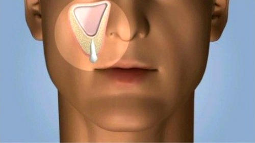 Перфорация гайморовой пазухи при лечении зуба thumbnail