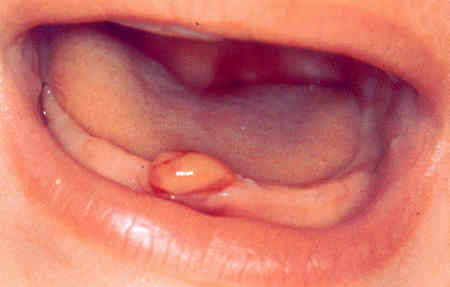 epulis pri prorezyvanii zubov