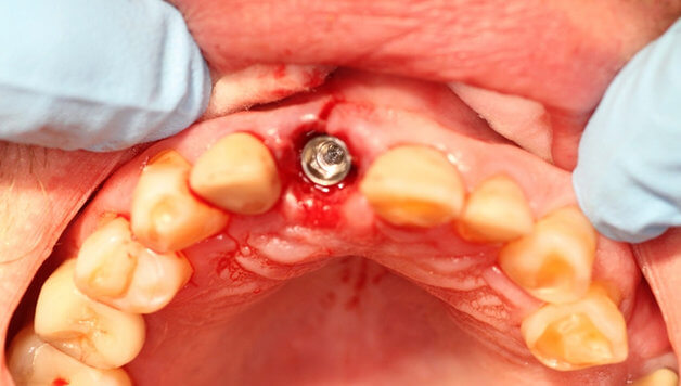 Последствия установки зубных имплантов в послеоперационный период