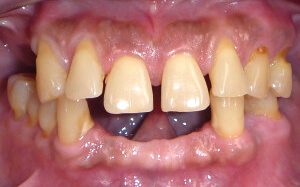 при пародонтозе можно ставить имплантанты зубов