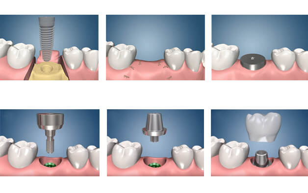 Пошагово как ставить импланты. Двухэтапная методика имплантации зубов. Этапы имплантации зуба абатмент. Одноэтапная и двухэтапная имплантация зубов. Двухэтапная имплантация зубов этапы.