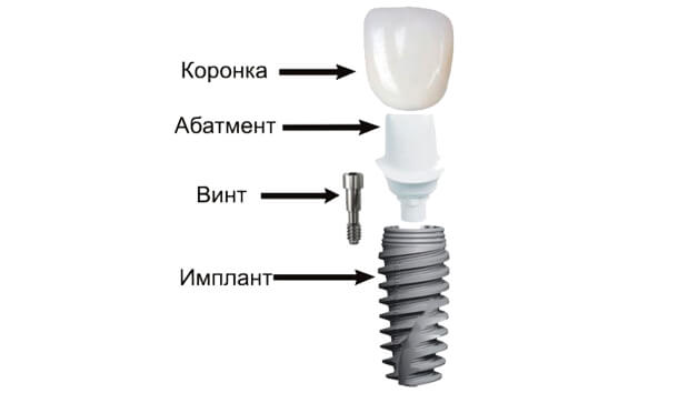 Схема импланта зуба