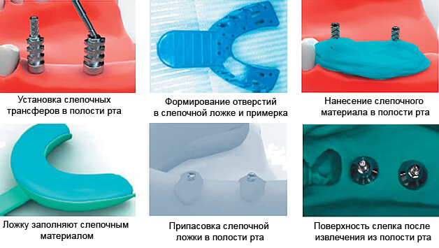 Слепок для импланта. Индивидуальная ложка для имплантатов. Слепочная ложка для имплантатов. Снятие оттиска с имплантатов.