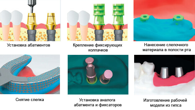 Слепок для импланта