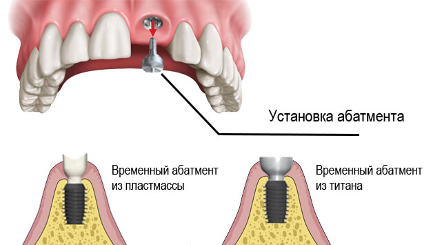 Абатмент временный что это такое. Смотреть фото Абатмент временный что это такое. Смотреть картинку Абатмент временный что это такое. Картинка про Абатмент временный что это такое. Фото Абатмент временный что это такое