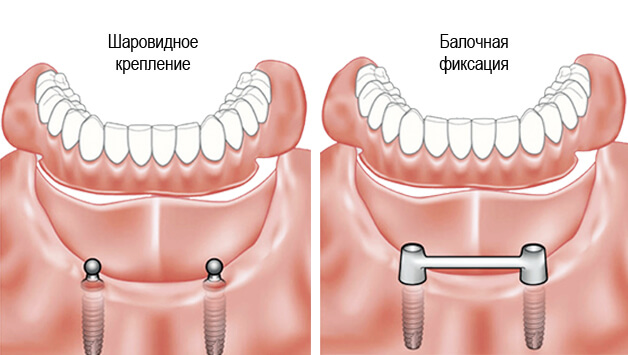 Как крепятся съемные. Балочная система фиксации протезов на имплантах. Балочная система фиксации протезов матрица. Балочная система фиксации коронок. Балочная система фиксации румпеля шредер.