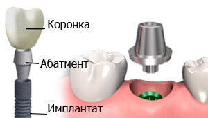 Абатмент — связующий переходник между установленным имплантатом и протезной конструкцией Абатмент