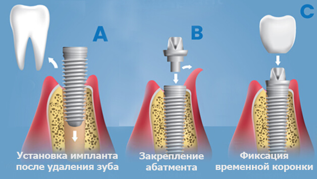 Транскатетерная имплантация митрального клапана