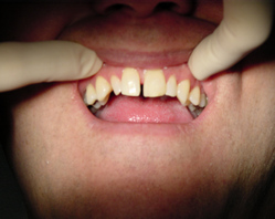 Фото 1. Диастема — щель между передними зубами