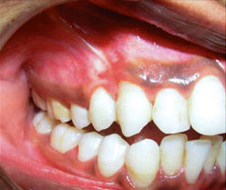 Антибиотик для лечения зубов и костной ткани зубов thumbnail