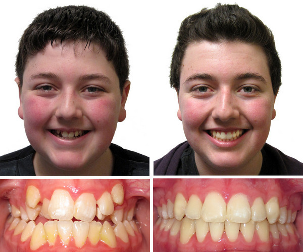 Перекрестный прикус зубов — фото, лечение, виды, диагностика