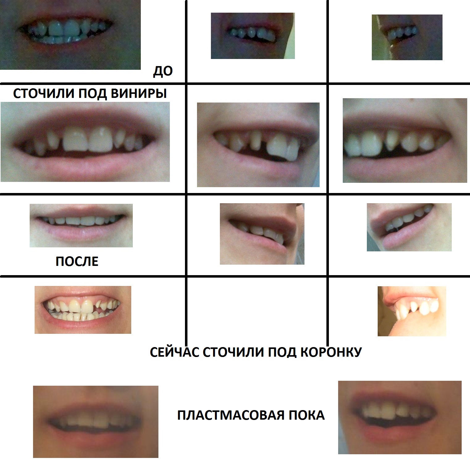 Бруксизм и виниры совместимы ли?