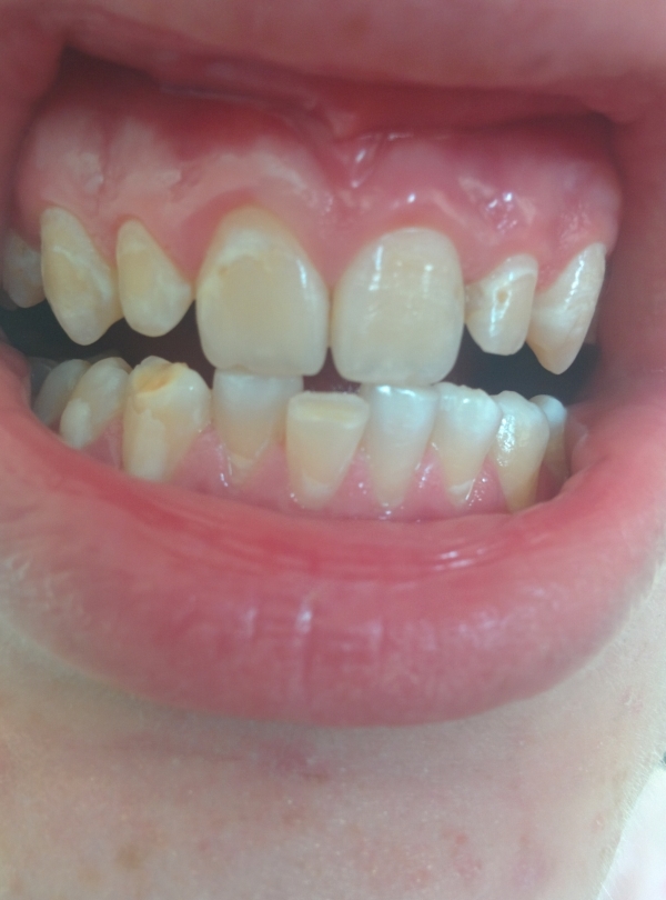 Желтые пятна на зубах и кариес, как исправить?