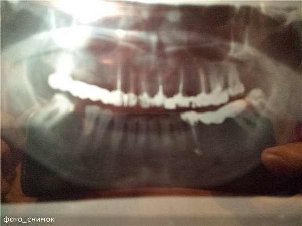 Онемение зуба: причины и лечение